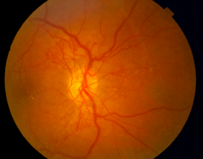 A blurry image of an eye with the retina in focus.