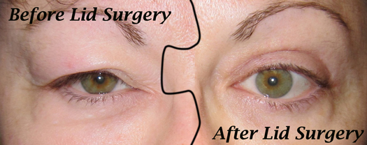 A woman 's eyes with surgery and after.