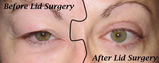 droopy eyelid surgery recovery time