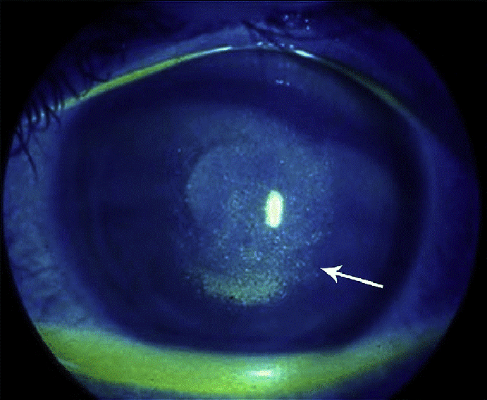 A close up of an eye with a white arrow pointing to the right.