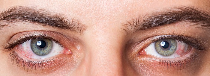A close up of the eyes of a person with red eye.