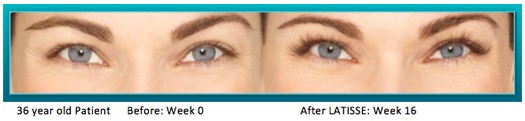 A woman 's eyes before and after using the botox method.