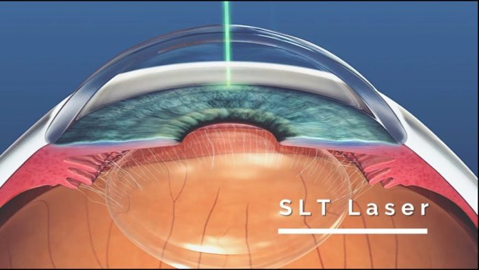 A close up of an eye with the slts logo