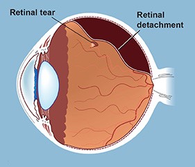 A close up of an eye with the retina tear and detachment