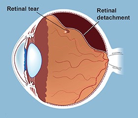 band around eye after retina surgery