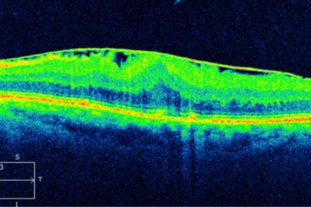 A picture of the eye showing light green and yellow.